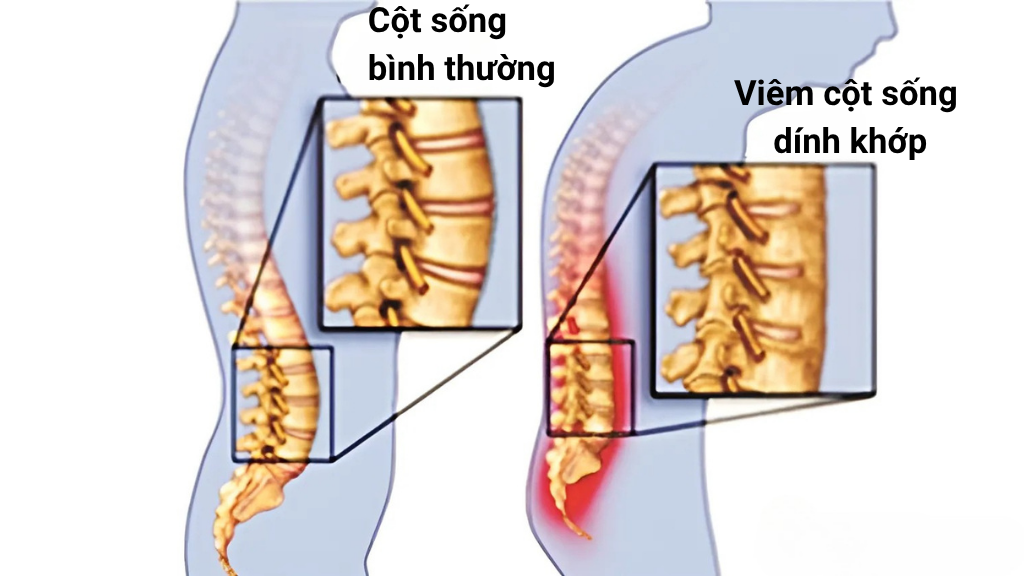 Viem cot song dinh khop