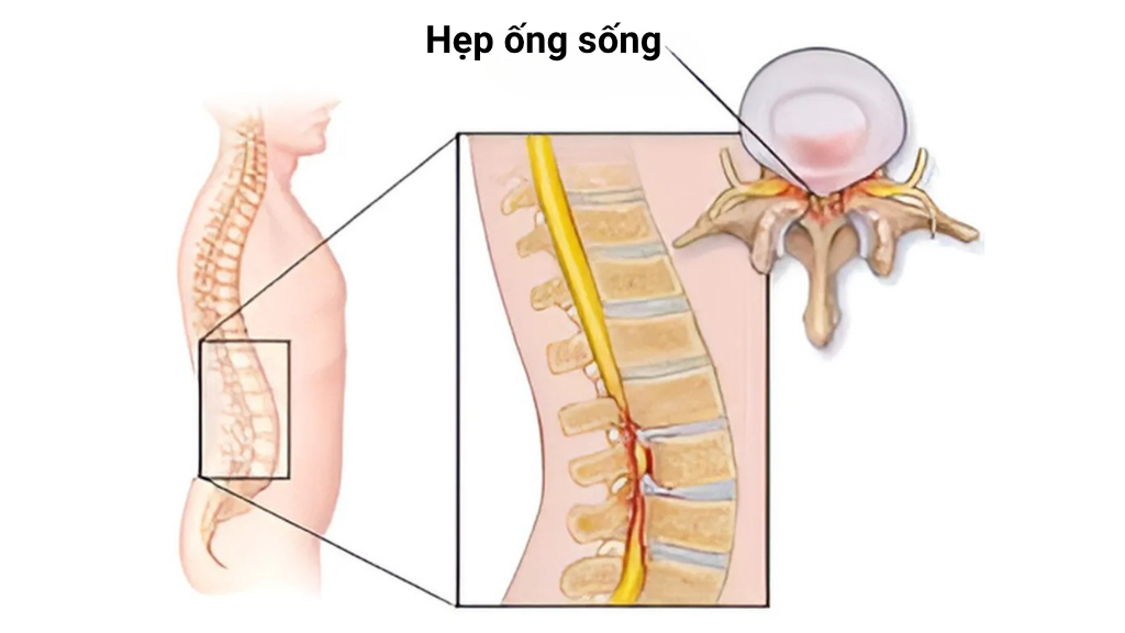 đau buốt sống lưng