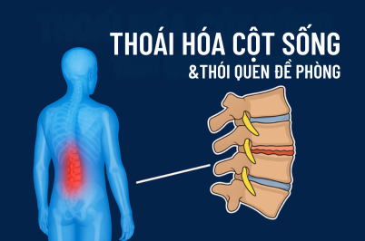 THOÁI HÓA CỘT SỐNG Ở NGƯỜI TRẺ VÀ XÂY DỰNG CÁC THÓI QUEN ĐỀ PHÒNG